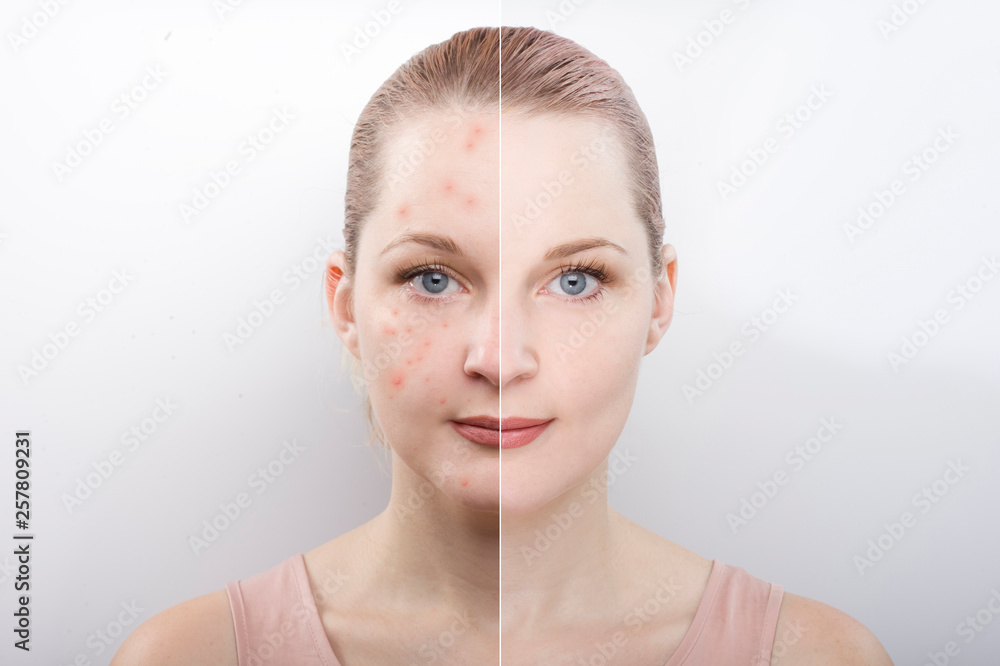 the girl's face before and after. difference after cosmetic procedures. Treatment of skin diseases. causes of acne. cleansing. - obrazy, fototapety, plakaty 