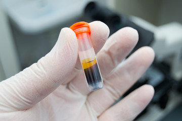 scientist holding in his hand a centrifuged blood sample with hemolysis