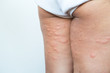 © NVB Stocker - Skin rash in the legs