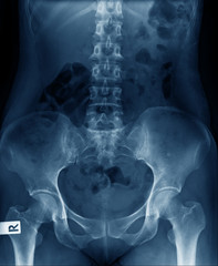 Wall Mural - old man x-ray, lumbar x-ray image with pelvic bone