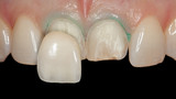 Fototapeta Konie - Zahn Veneer aus Keramik auf den oberen großen Schneidezähnen Behandlungsablauf