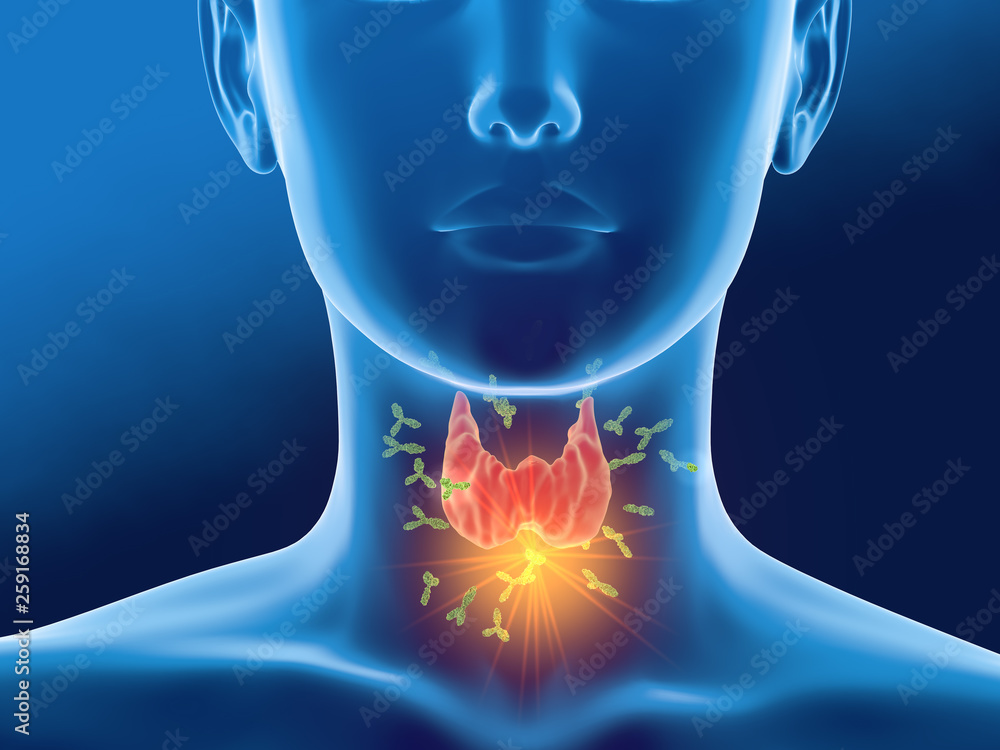 Antibodies attacking thyroid gland of a woman,  Autoimmune thyroiditis, Hashimoto's disease .. - obrazy, fototapety, plakaty 