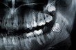 Dental x-ray of a young female molars with teeth problems, fillings and medical care needed. Wisdom tooth. 