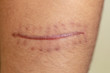 © sinhyu - A scar is an area of fibrous tissue that replaces normal skin after an injury on skin.