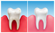 Vector illustration of gum disease -  periodontitis in compare with healthy white tooth