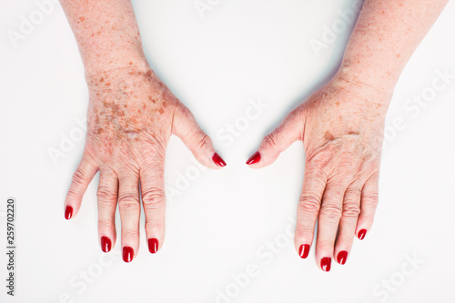 Flabby Arms In Wrinkles And Age Spots Stock Photo Adobe Stock Flabby Arms In Wrinkles And Age Spots Stock Photo Adobe Stock