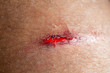 Closeup view of a bloody laceration on human skin
