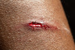 © Alessandro Grandini - Closeup view an open flesh wound on a person
