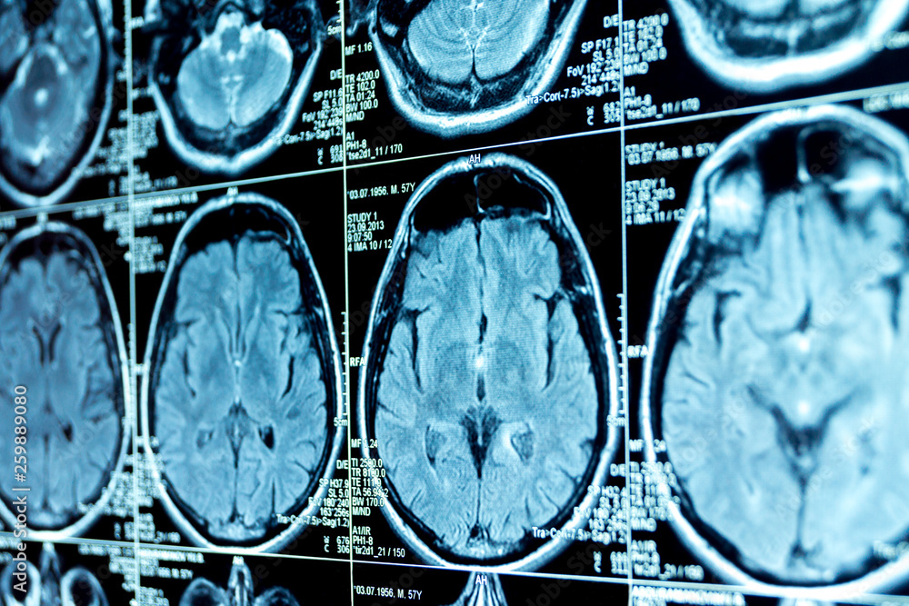 MRI scan of the brain Stock Photo | Adobe Stock