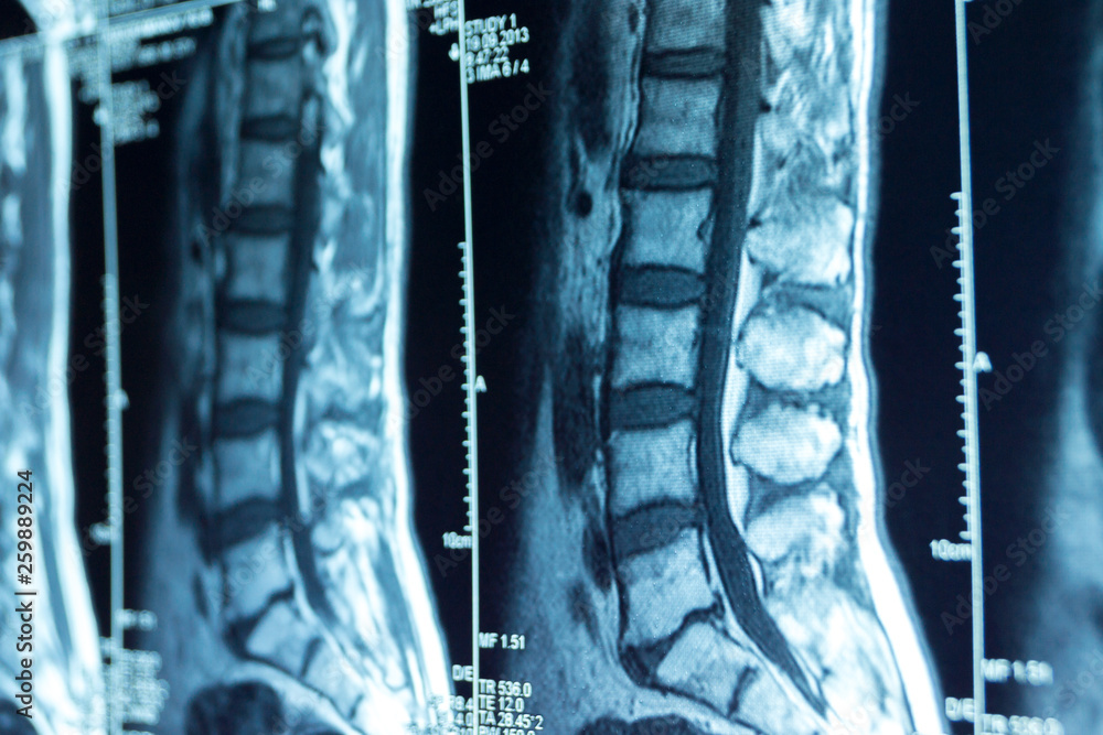 MRI scans of the lumbosacral spine Stock Photo | Adobe Stock