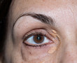 Closeup of woman with xanthelasma