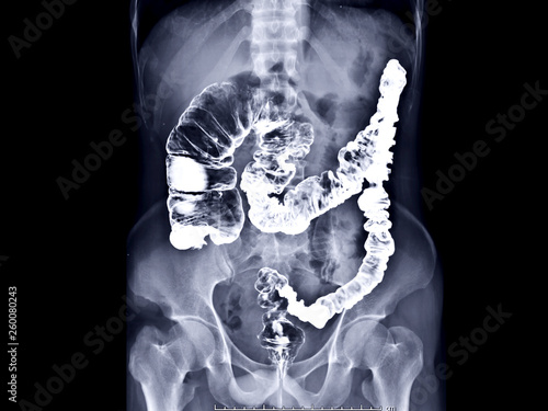 barium enema image or x-ray image of large intestine AP view showing anatomical of large intestine or colon for diagnosis Colorectal cancer.