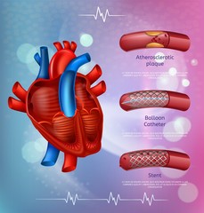 Medical Banner Atherosclerosis Treatment Methods