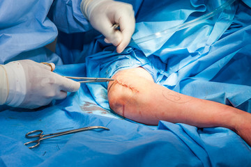 Surgeon suturing the arm of a patient at the end of surgery