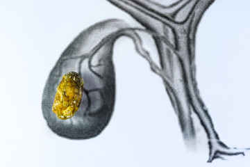 Gall bladder stone, schematic depiction, large sized Gallstone, Result of gallstone disease.