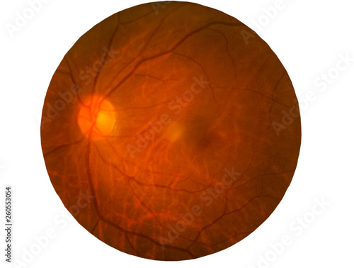 Cuadros en Lienzo Retina of diabetes , diabates retinopathy,photo Medical Retina Abnormal isolated on white background