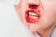 a young woman with a bloody nose.