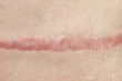 Close up of cyanotic keloid scar caused by surgery and suturing, skin imperfections or defects. Hypertrophic Scar on skin, dermatology and cosmetology concept
