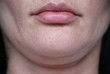face line correction. a woman with a second chin RF-lifting.