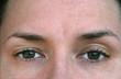 © Angelina - Ptosis. eyelid syndrome