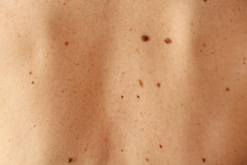 Human skin with moles