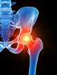 © Sebastian Kaulitzki - 3d rendered medically accurate illustration of the hip joint showing pain