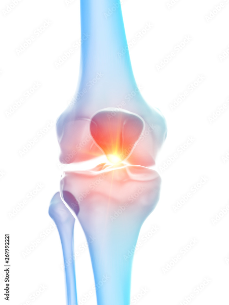 3d rendered medically accurate illustration of the knee joint showing pain - obrazy, fototapety, plakaty 
