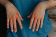 Derma problem on hands. Scratching hands