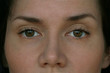 © Angelina - ptosis of the upper eyelid in a woman