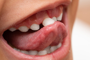 A closeup view on the mouth of a young boy with wibbly front teeth, moving one of the incisors forward with his tongue.