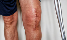 Man On Crutches After Knee Replacement Surgery, Stitches Close Up. Painful Scar After Knee Surgery
