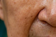 © eyepark - Acne, Small pimple is on senior woman's nose, Deep groove cheeks, Close up and macro shot, Selective focus, Asian Body skin part, Healthcare and Beauty concept