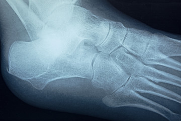 Detail of the x-ray of the bones of the human right foot