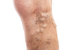 © Thunderstock - Closeup of patient leg with vascular issues