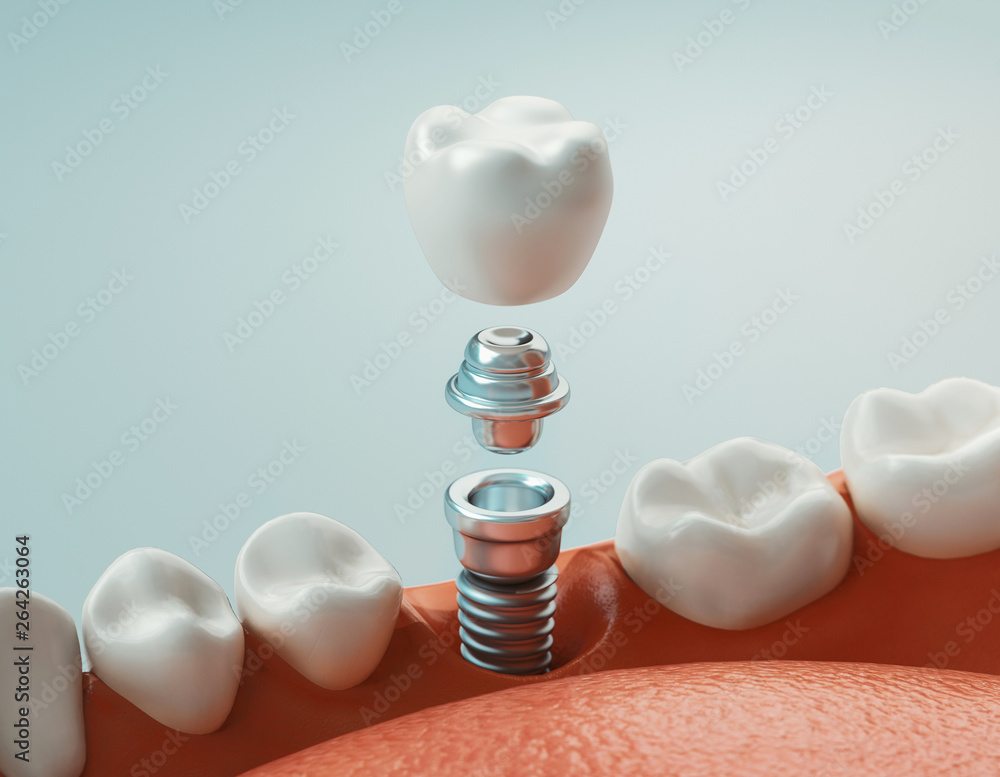 Dental care, dental implant, 3d rendering - obrazy, fototapety, plakaty 
