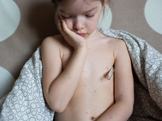 sad girl with chickenpox