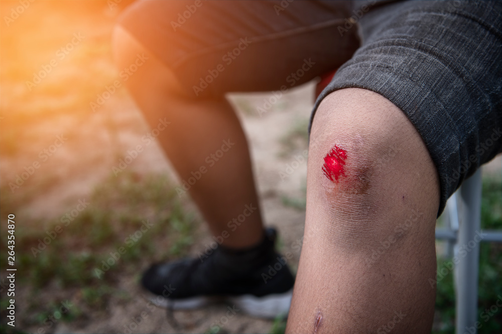 Knee wound from fall and bleeding Stock Photo | Adobe Stock