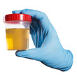 © Yeti Studio - Hand in a blue glove holding medical urine test, isolated on white background