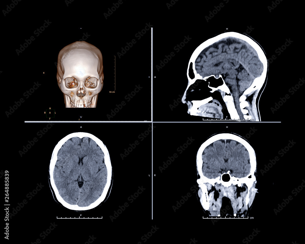 Coronal Sagittal Axial Ct Scan