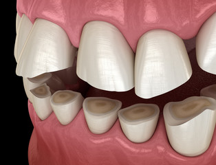 Wall Mural - Dental attrition (Bruxism) resulting in loss of tooth tissue.  Medically accurate tooth 3D illustration