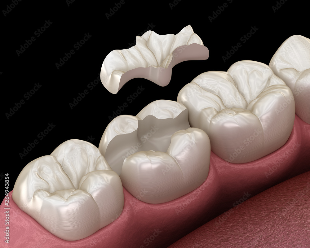 Inlay ceramic crown fixation over tooth. Medically accurate 3D illustration of human teeth treatment