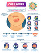 © VectorMine - Cold sores vector illustration. Medical labeled herpes simplex virus scheme