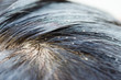 Lice eggs on the child's head cause head itching. Girls with long hair are more likely to develop lice than short hair.