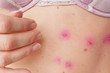 skin rash treatment on woman body. Shingles, Disease, Herpes zoster, varicella-zoster virus. skin rash and blisters on body	