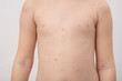 © Volodymyr Shcherbak - Chickenpox, also known as varicella, is a highly contagious disease caused by the initial infection with varicella zoster virus
