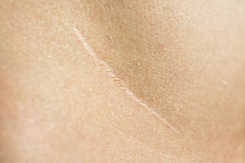 Close-up, Beautiful Surgical Scar On The Skin After Appendectomy 