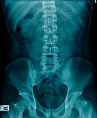 Poster - x-ray human spine, l-spondylosis and compression fracture 