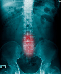 Poster - x-ray human spine, l-spondylosis and compression fracture 