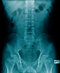 Poster - x-ray human spine, l-spondylosis and compression fracture 