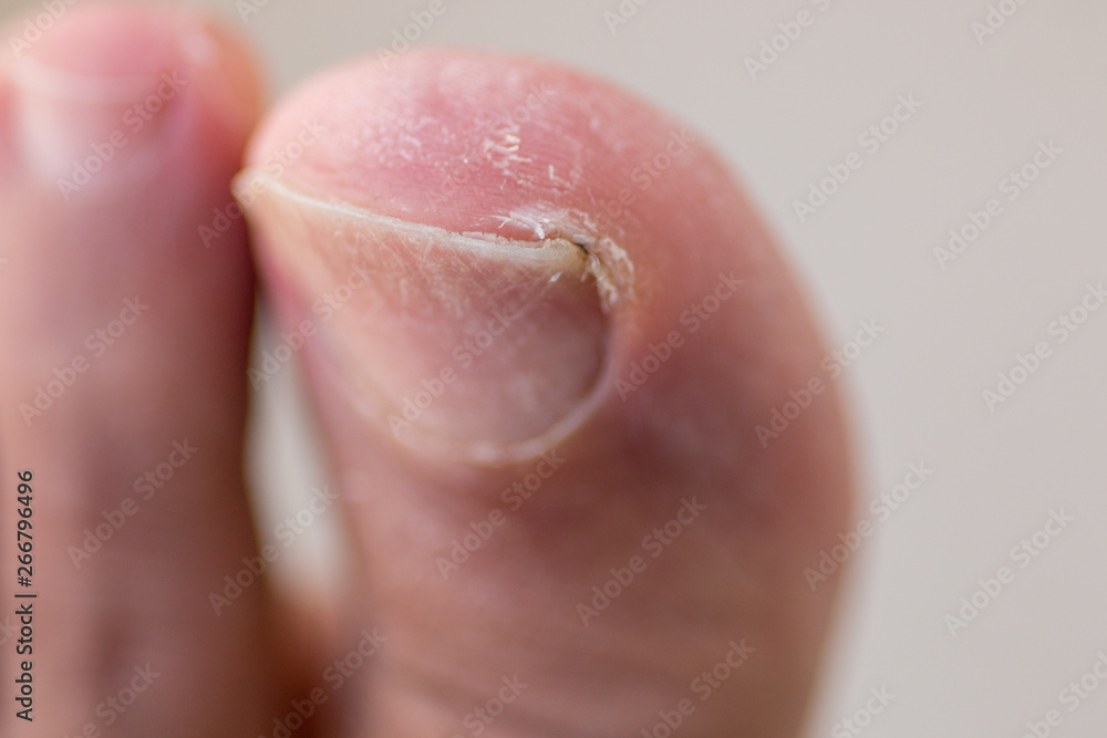 Big Toe with Ingrown Toenail, Scaly, Dry Skin and Cracking
